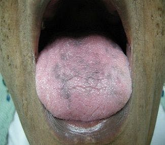 68-Year-Old Woman With a History of Aggressive NHL Presents With Tongue Hyperpigmentation 