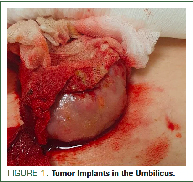 FIGURE 1. Tumor Implants in the Umbilicus.
