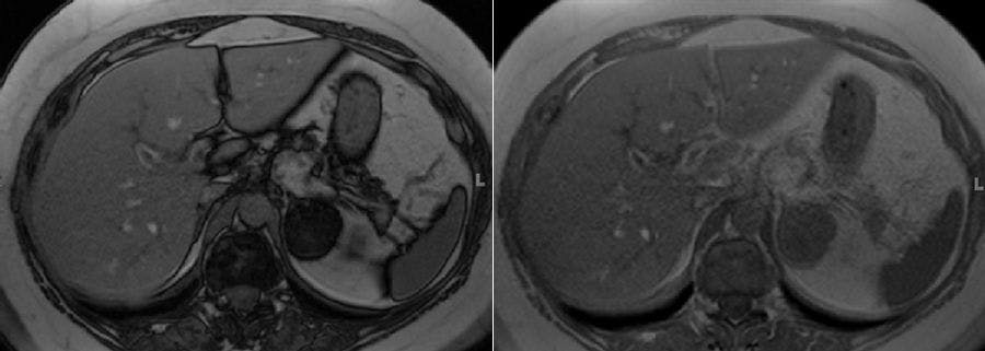 Adrenal Lesion Discovered in 50-Year-Old Patient