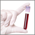 Blood-Based Test May Detect Early-Stage Pancreatic Cancer