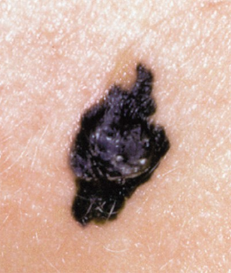 Sentinel-Node Biopsy Reduced Recurrence, Increased Melanoma-Specific Survival