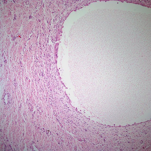 Cystic Tumor Found in 42-Year-Old Patient