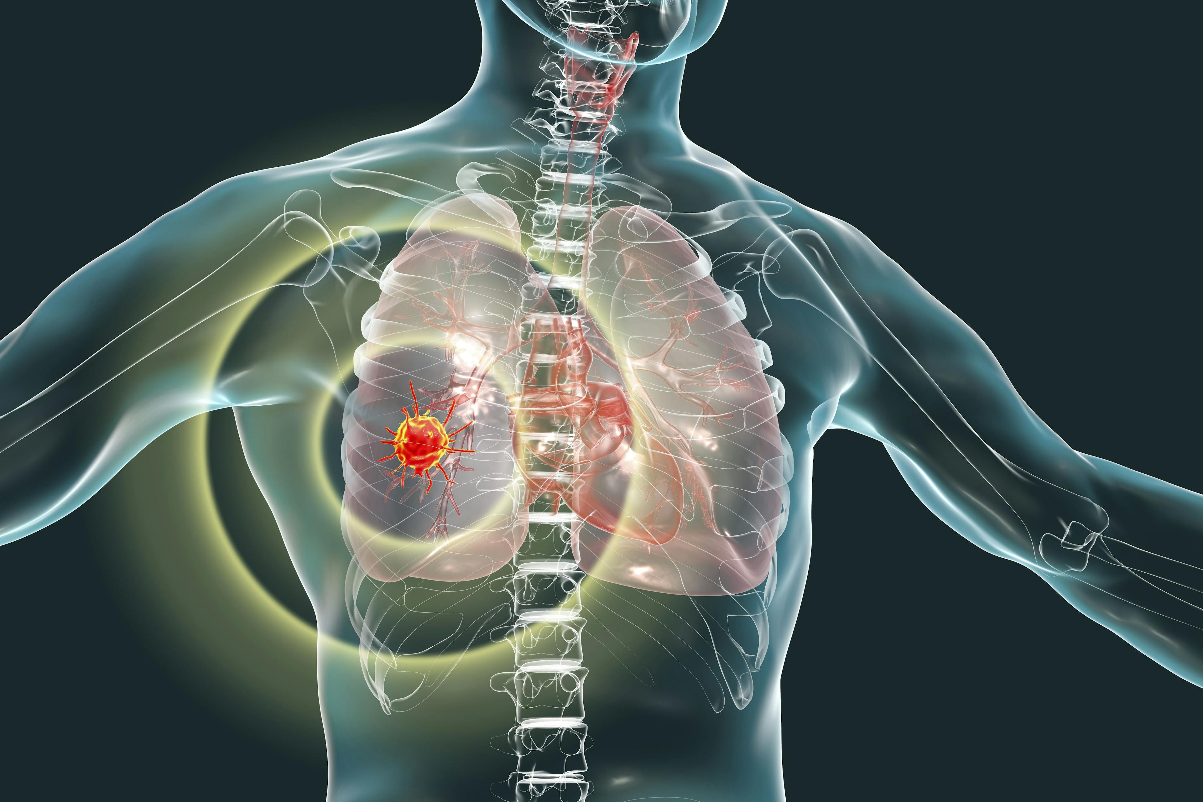 Tislelizumab Maintains OS Benefit vs Docetaxel in Previously Treated NSCLC
