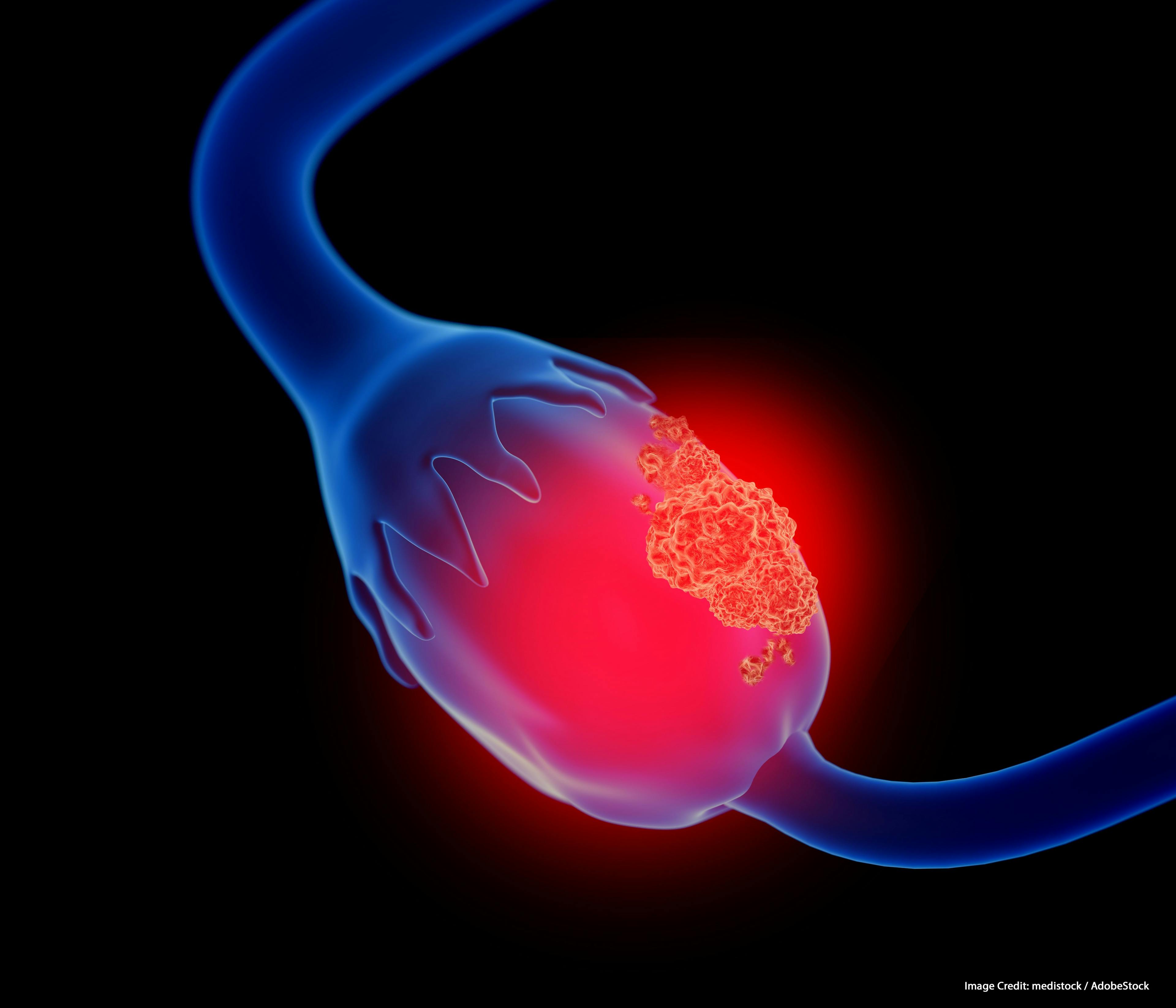 Evaluating Olaparib for BRCA Wild-Type Platinum-Resistant Ovarian Cancer