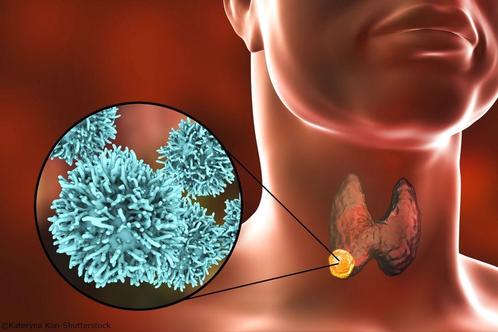 Could Leukocyte DNA Methylation Patterns Inform Treatment of Thyroid Cancer?