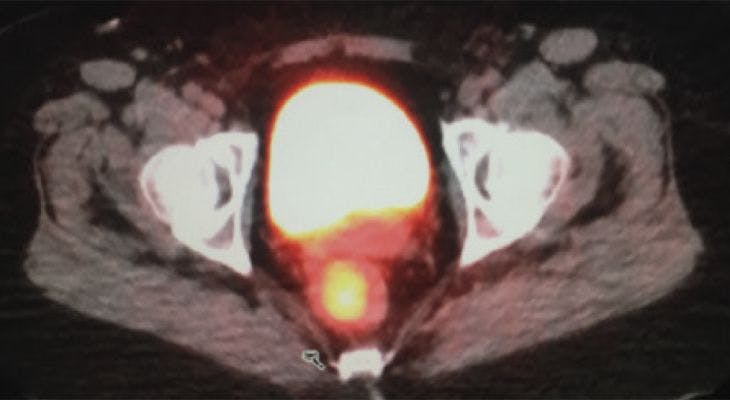 Woman With Rare Cause of Rectal Bleeding 