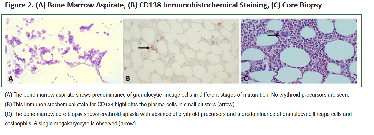 Figure 2. (A) Bone Marrow Aspirate, (B) CD138 Immunohistochemical Staining, (C) Core Biopsy