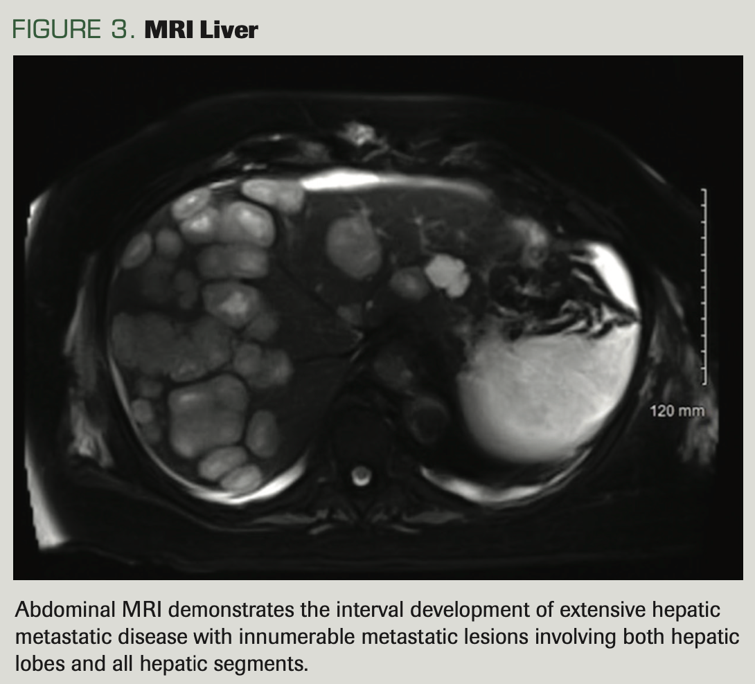 A Rare Case of Glioblastoma With Extensive Liver Metastases