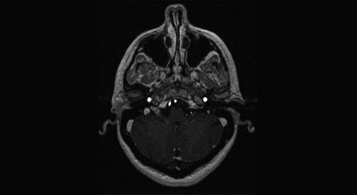 A 45-Year-Old Woman With an Incidental Finding on MRI