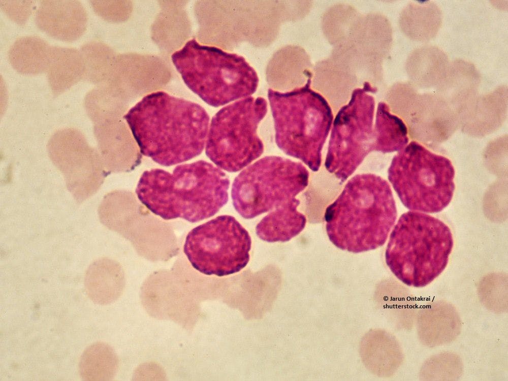 Genes may aid prognostics in acute myeloid leukemia