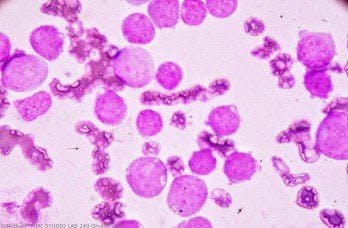 Enasidenib: A Promising Option for IDH2-Mutated Acute Myeloid Leukemia?