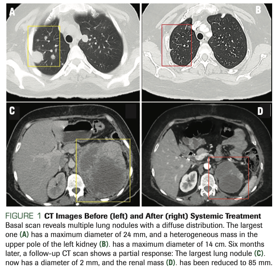 FIGURE 1 CT Images Before (left) and After (right) Systemic Treatment Basal scan reveals multiple lung nodules with a diffuse distribution. The largest one (A) has a maximum diameter of 24 mm, and a heterogeneous mass in the upper pole of the left kidney (B). has a maximum diameter of 14 cm. Six months later, a follow-up CT scan shows a partial response: The largest lung nodule (C). now has a diameter of 2 mm, and the renal mass (D). has been reduced to 85 mm.