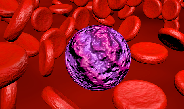 acute myeloid leukemia