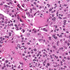 Medullary Thyroid Cancer in a 28-Year-Old Male