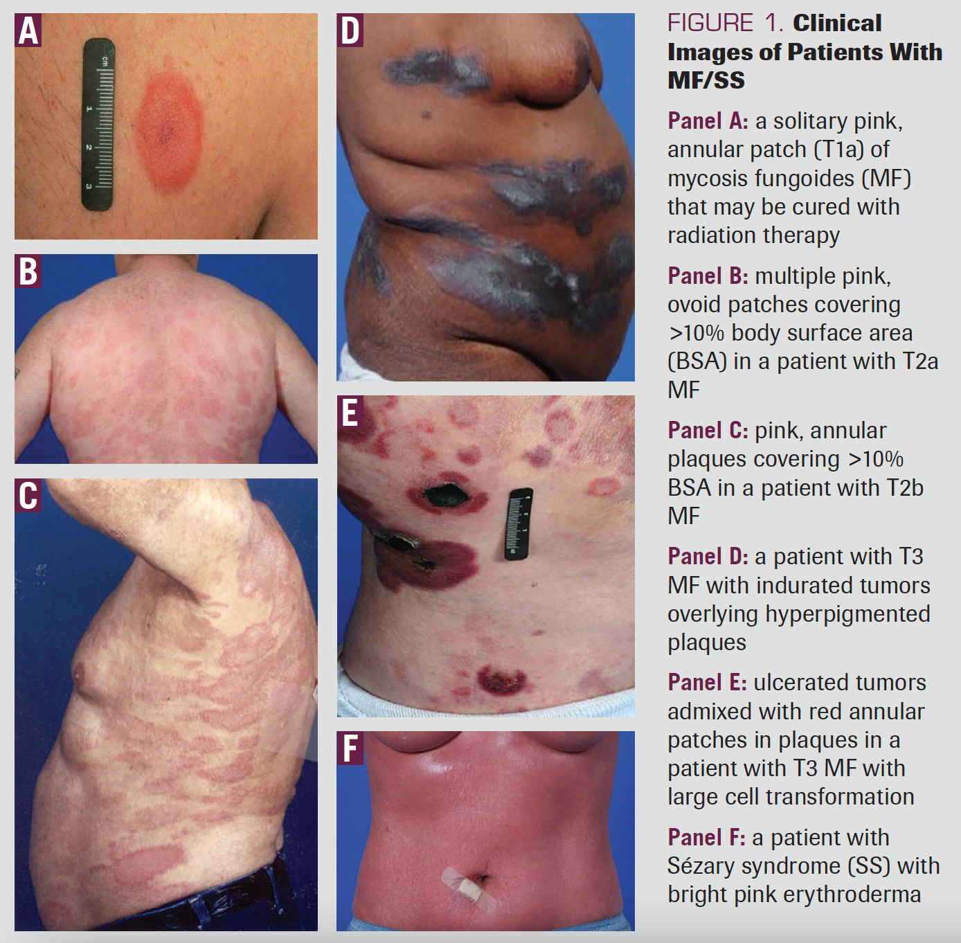 FIGURE 1. Clinical Images of Patients With MF/SS