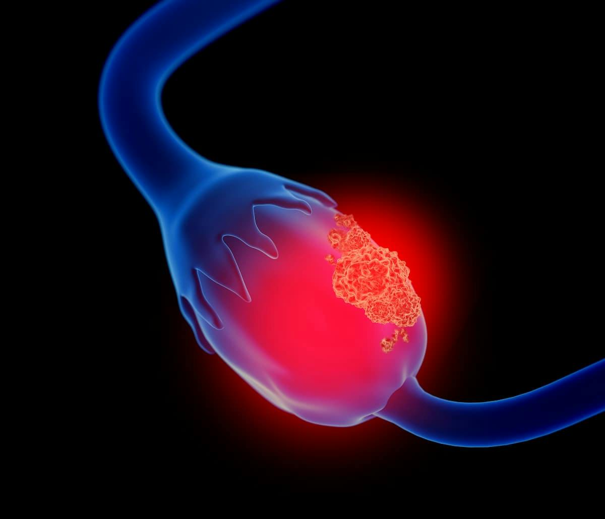  Addition of Dual Checkpoint Blockade Inhibition Improves PFS in Ovarian Cancer  |  Image Credit: © Lars Neumann - stock.adobe.com.