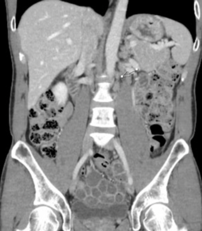 FIGURE 2. Coronal CT Abdomen and Pelvis Showing Several Foci of Periaortic Lymphadenopathy