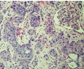 Incidental Primary Squamous Cell Carcinoma of the Kidney Within a Calyceal Diverticulum Associated With Nephrolithiasis