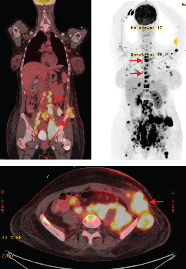 Unusual Clinical Presentation of Clear Cell Sarcoma in a Young Woman