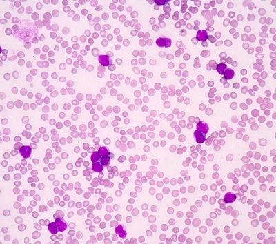 Findings from a study indicate that measurable residual disease clearance is associated with favorable outcomes in acute myeloid leukemia following subsequent therapy before allogenic stem cell transplant.