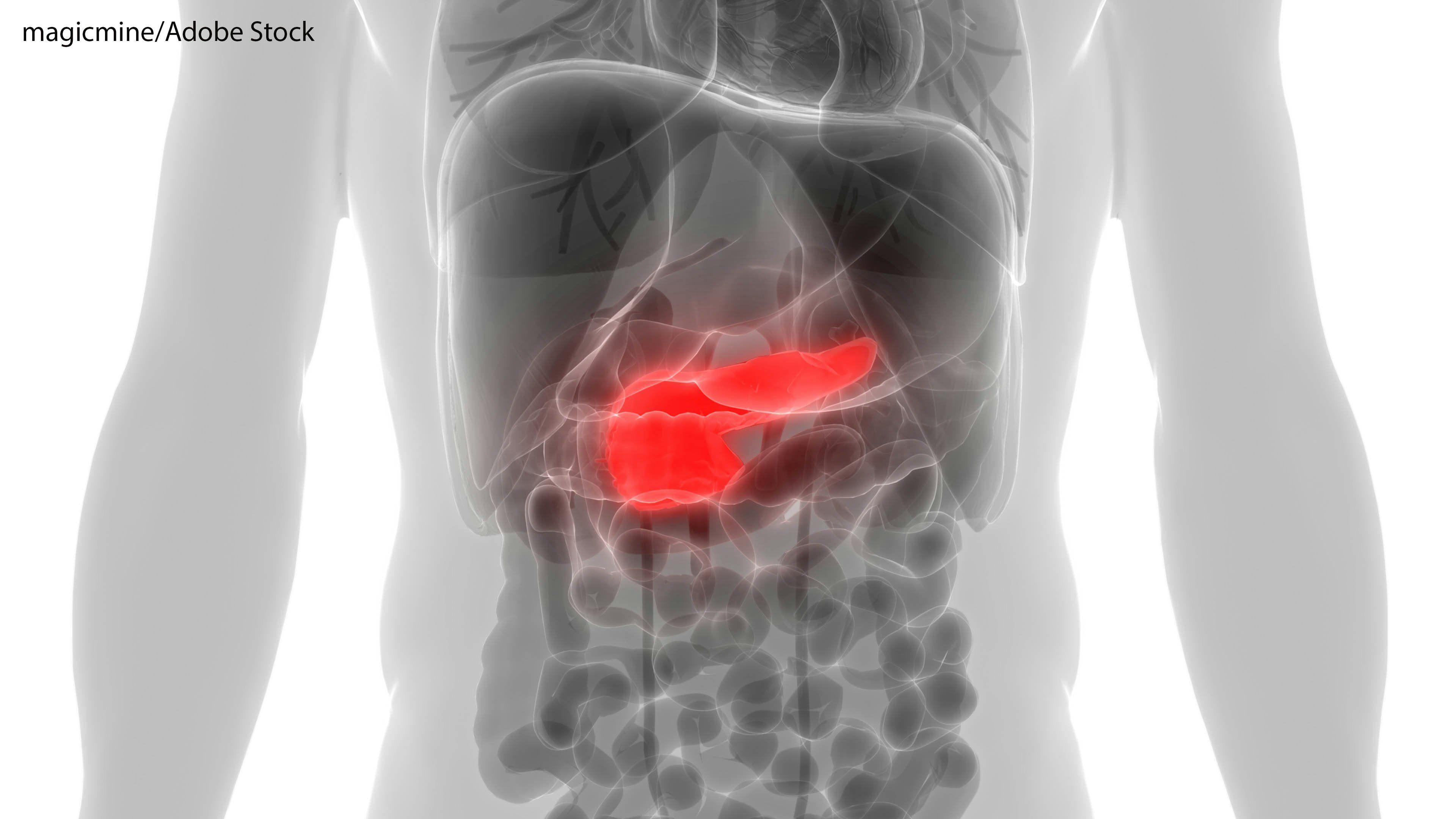 Stereotactic Body Radiation Therapy Improves OS for Locally Advanced Pancreatic Cancer