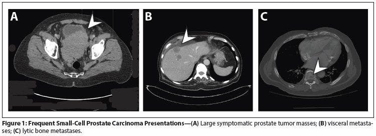 Neuroendocrine (Small-Cell) Carcinomas: Why They Teach Us Essential Lessons About Prostate Cancer