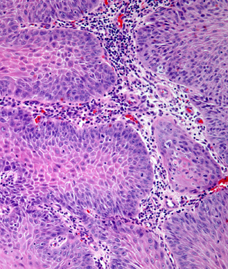 Squamous cell carcinoma of the head and neck