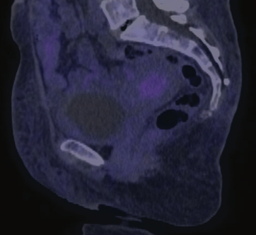 FIGURE 3. Response Assessment PET-CT Scan. The image reveals the absence of metabolic uptake.