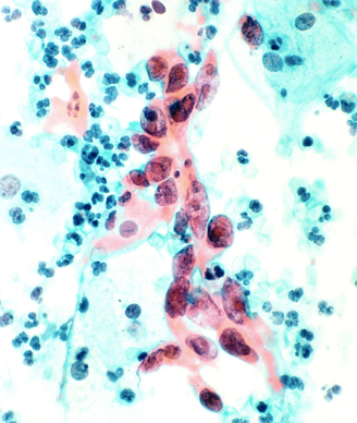 Cytological specimen showing cervical cancer