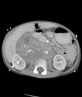 Neuroblastoma, CT of the abdomen